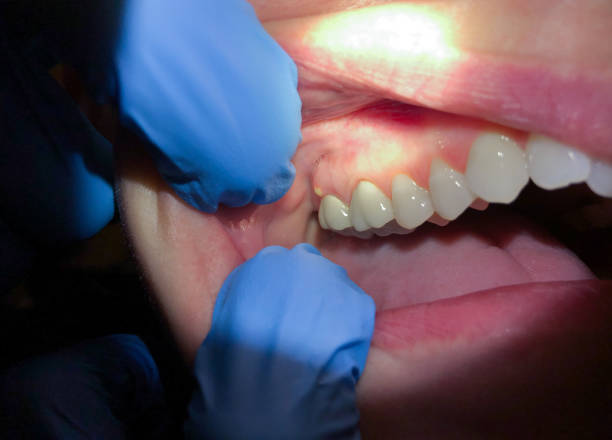 Best Emergency Care for Gum Disease in Cecil Bishop, PA